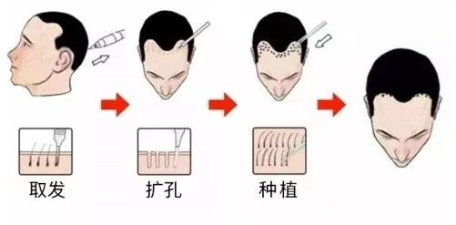 世界最新脫發(fā)治療技術(shù)全解析，零基礎(chǔ)入門，步步為營的治愈攻略